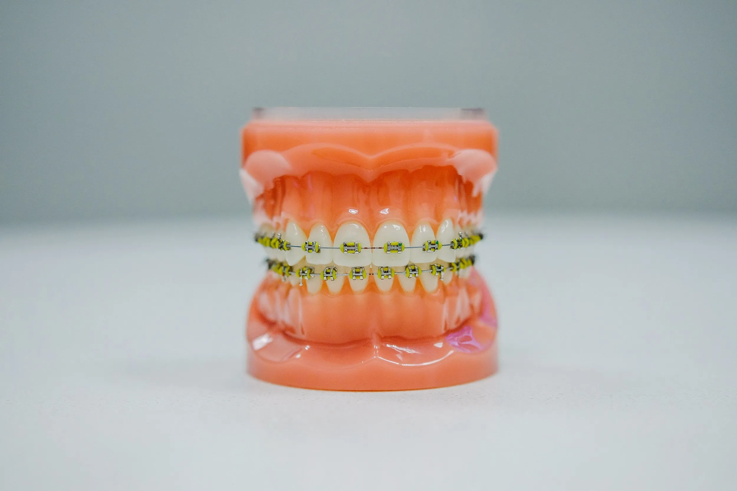 A dental model fitted with orthodontic braces.
